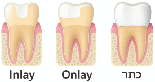 השוואה בין כתר Inlay onlay
